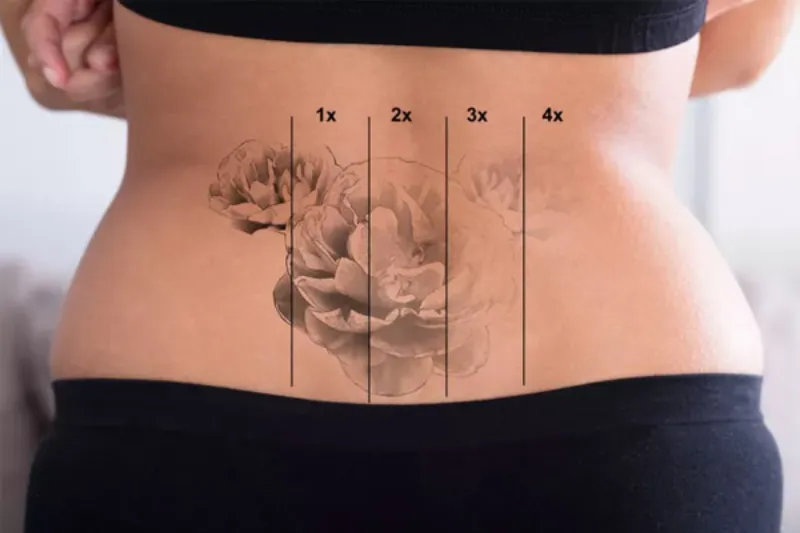 Remoção de Tatuagem