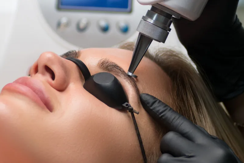 Remoção de micropigmentação